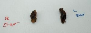 Cerumen removed from the right and left ears of a 4-year-old child with significant earwax buildup